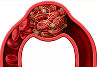 令人“闻风丧胆”的脑卒中发明治疗新机制！