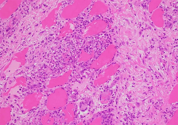 【玩彩网助力】治疗结节病的KBMAB-16获FDA批准临床